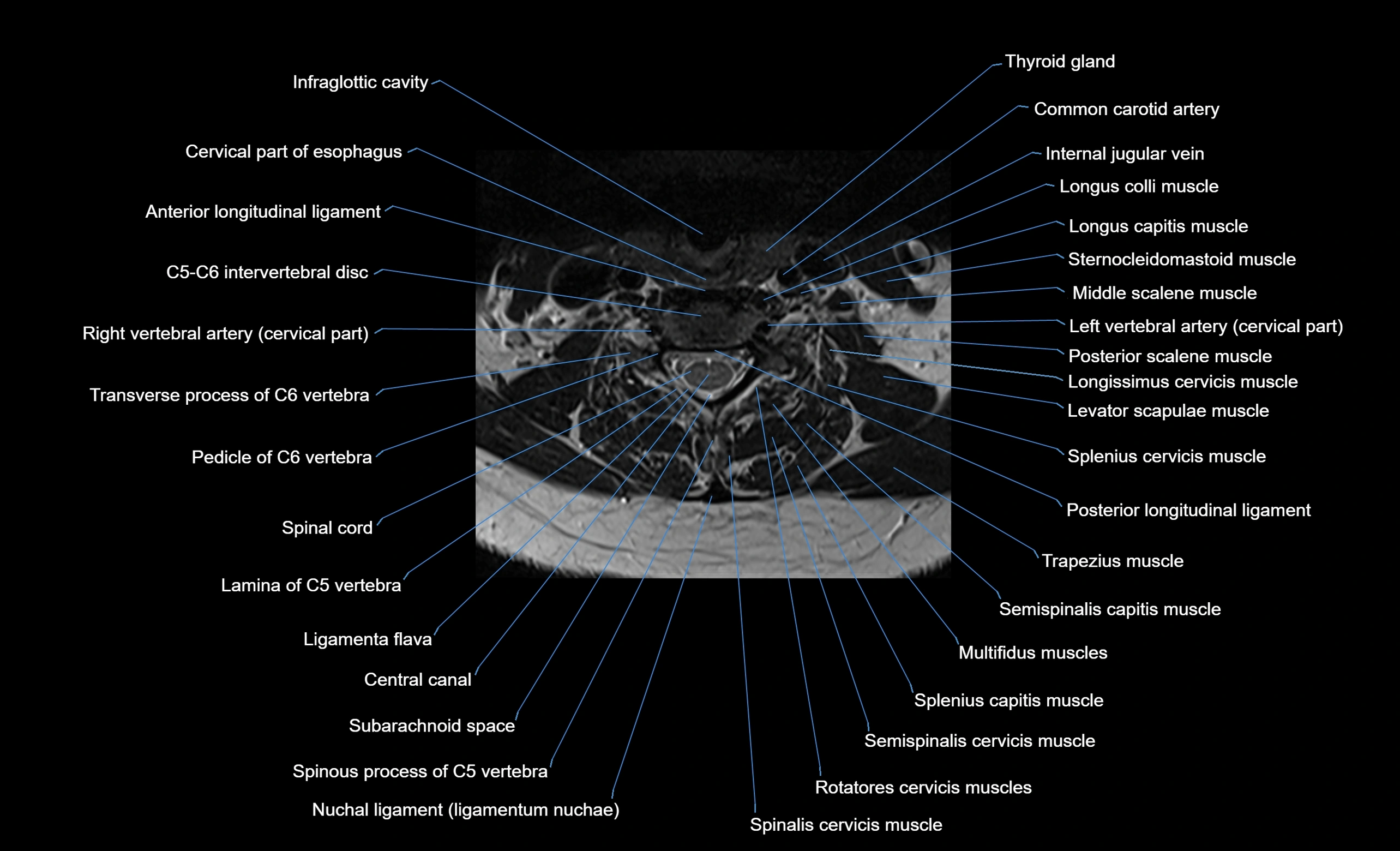 cervical spine cross sectional MRI anatomy  3T MRI axial  image-img-00001-00030.webp